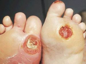 Bệnh loét bàn chân do biến chứng của bệnh tiểu đường
